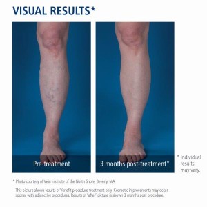 05_Leg_Before_After_Photo